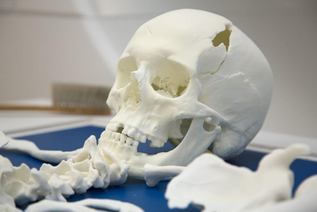 KRIII skull reconstruction